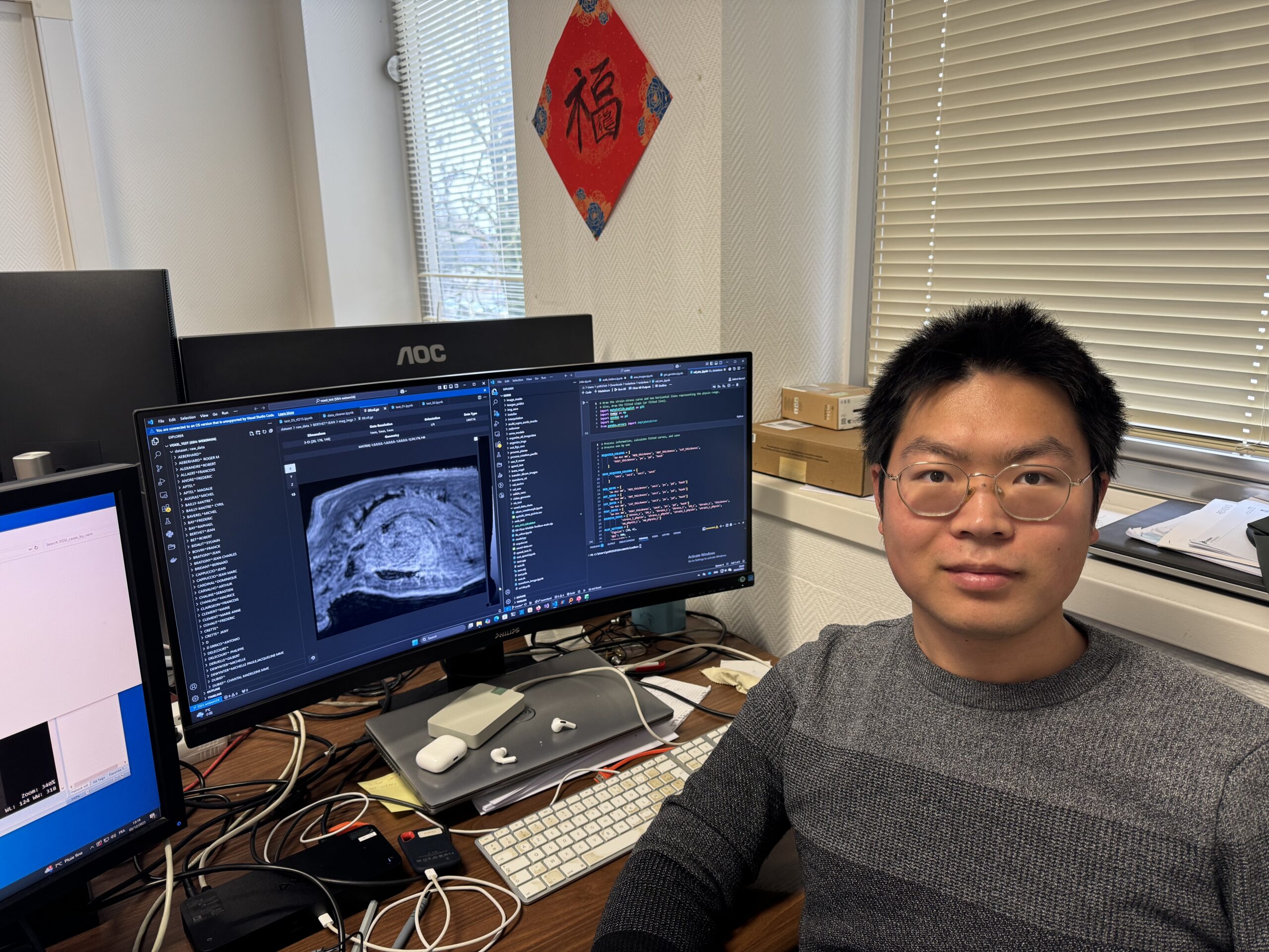 L&rsquo;Intelligence Artificielle au service de la prédiction de rupture de l&rsquo;Aorte